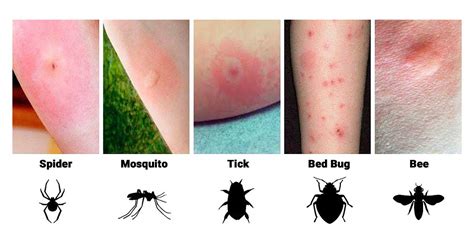 How to Identify Insect Bites: 12 Bug Bites & Stings.
